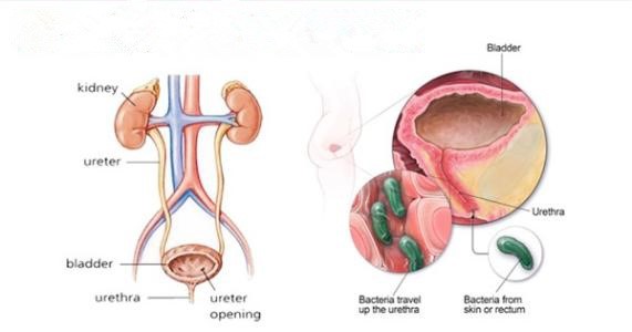尿频尿急憋不住尿，难道还有女性前列腺炎？
