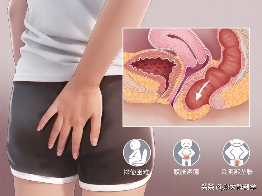 女性盆底功能障碍性疾病表现,盆底功能障碍会引起失眠吗