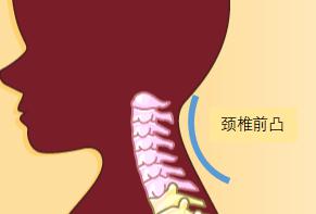 颈椎生理曲度变直严重吗要治疗吗,颈椎胸椎生理曲度变直症状