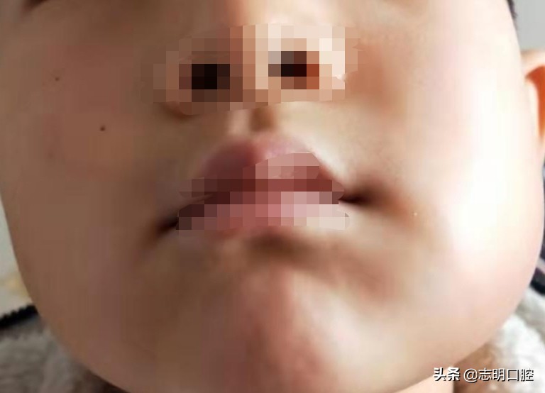 新冠时期宝宝牙病急缓如何应对