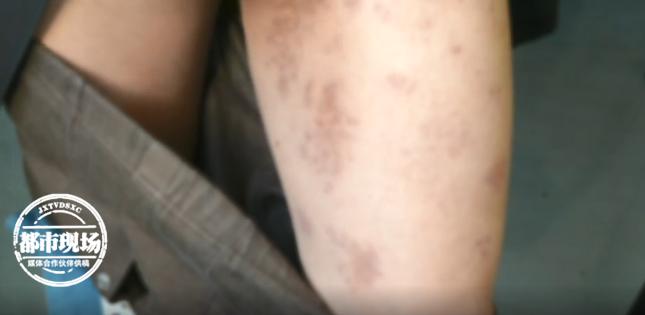 每年夏天左脚长水泡怎么回事,左腿突然长几个水泡怎么治疗