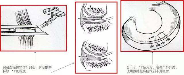 半月板二度损伤适合缝合手术吗,半月板损伤手术缝合效果好吗