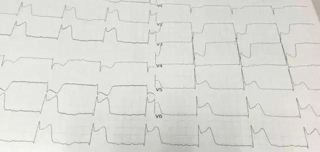 32岁北大博士心梗猝死,知名医生突发心梗