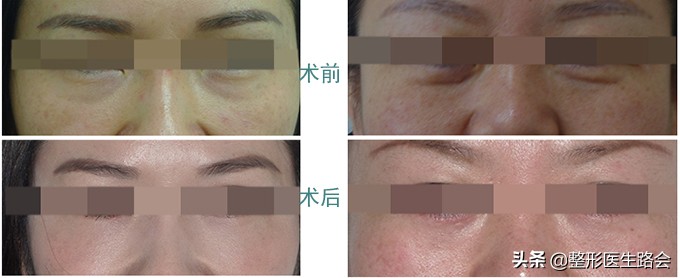 如何区分结构性泪沟,泪沟太明显怎么自己改善