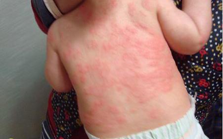 春季婴儿湿疹高发日常护理很关键,哺乳期孩子湿疹家长需要排湿气吗