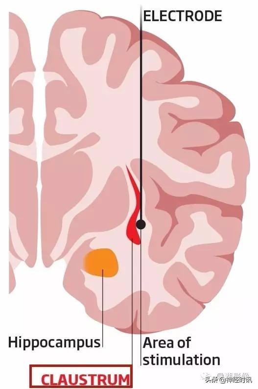 基底节ct解剖示意图,影像解剖图谱怎么用