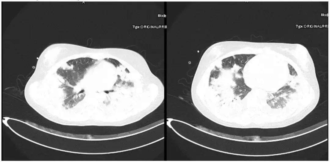 万古霉素用于mrsa的作用机制,万古霉素无效还有什么抗生素可用
