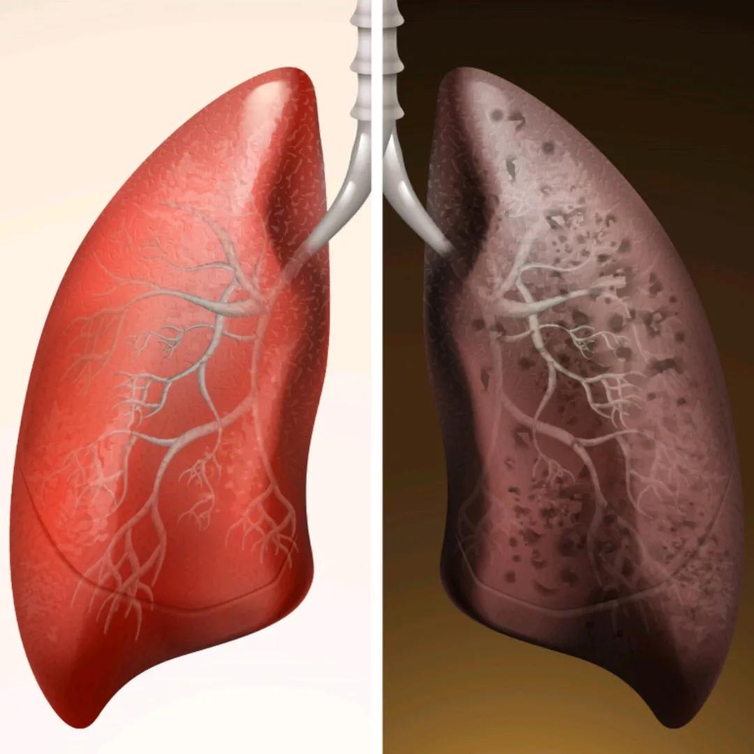 血压高了为什么会引发尿毒症，有什么症状，如何避免？医生讲清楚