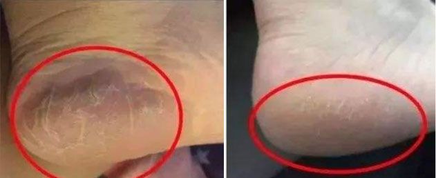 后脚跟干裂护足霜排行榜第一名,护脚霜脚后跟干裂修复霜国货