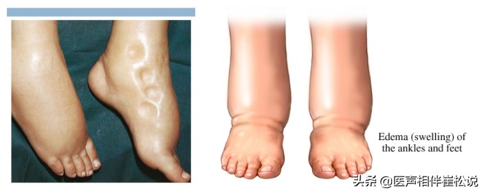脚肿？腿肿？脸肿？眼泡肿？这些水肿要注意了