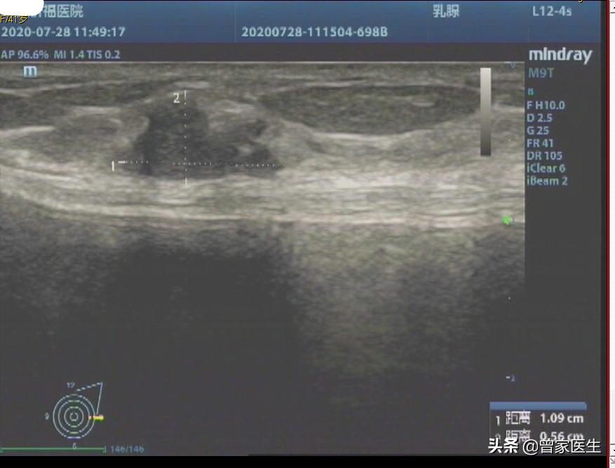 乳腺检查bi-rads4a严重么,乳腺彩超4a纵横比大于1