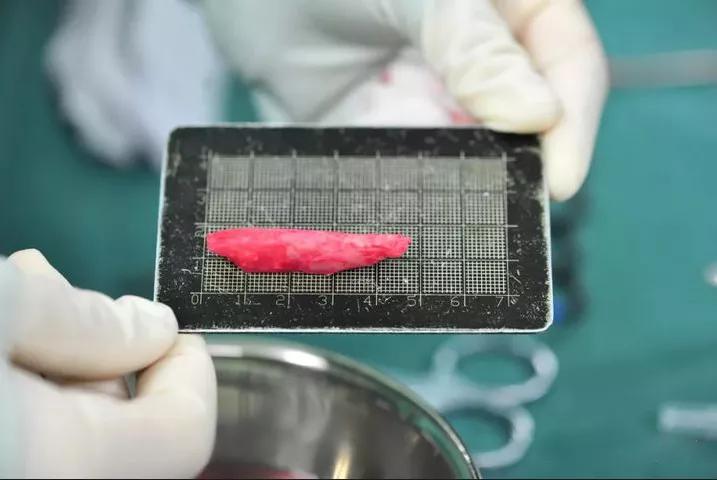 膨体材料真的很难取吗,膨体怎么取出来