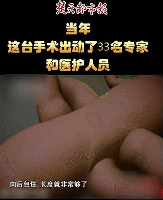 中国首例坐骨连体婴,坐骨连体姐妹分离成功了吗