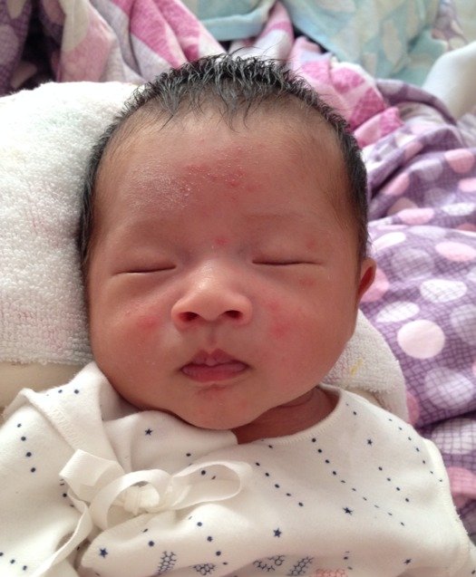 月嫂面试湿疹怎么处理,月嫂一走就长湿疹