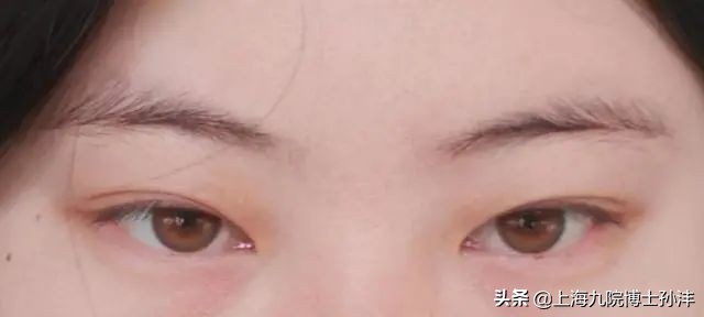明明是双眼皮却老是不显为什么,为什么割了双眼皮反而不好看了