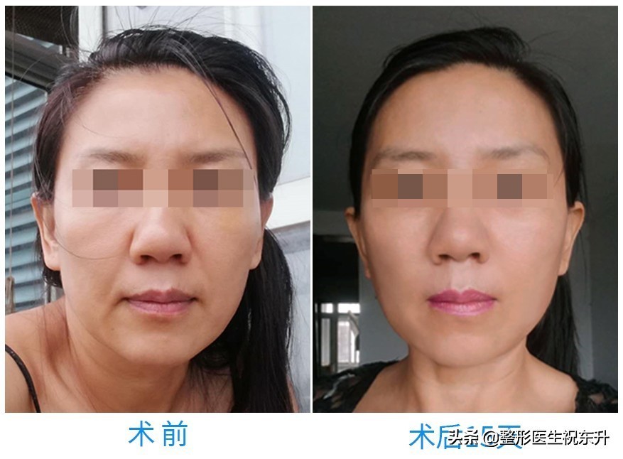 线雕15天脸部凹陷越来越严重,小切口和线雕有什么区别