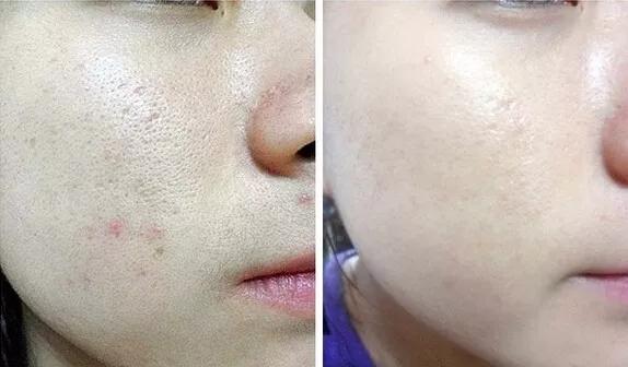 有黑头和没黑头有什么区别,没有长过黑头却长黑头怎么办