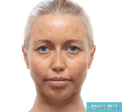 线雕后脸变宽眼睛变小了,线雕后脸变宽了多久能恢复