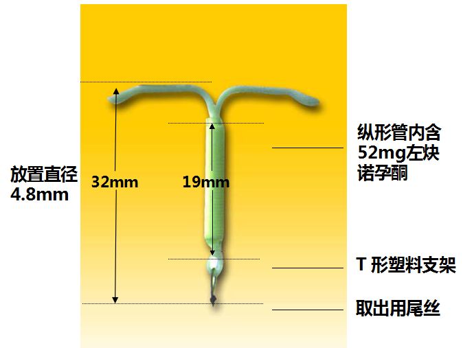 曼月乐环是怎么消炎的,曼月乐环是怎么放进去的