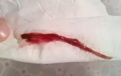 内裤的分泌物什么样是正常,短裤上有黄色的分泌物怎么办