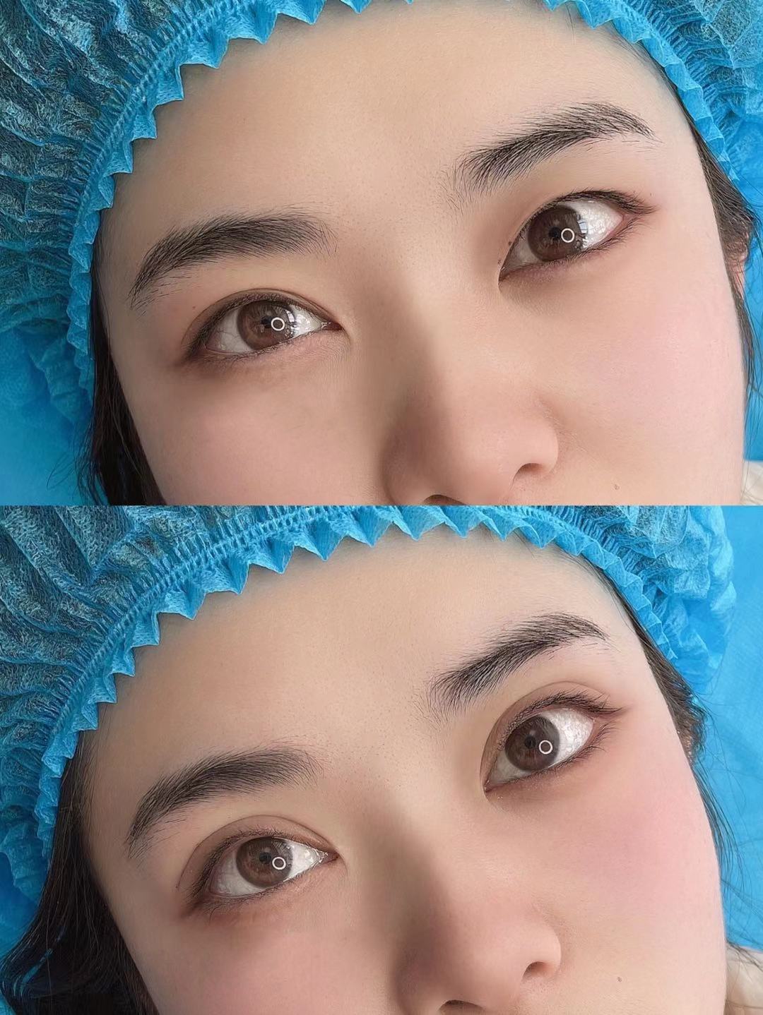 两点微创双眼皮是永久的吗,微创双眼皮术后眼角特别红