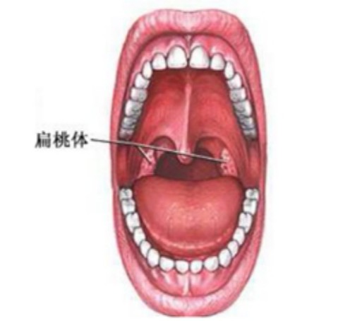 扁桃体肥大重度保守治疗有效果吗,扁桃体肥大做手术怎么做