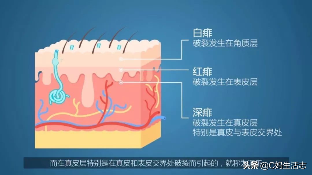 长痱子怎么办小妙招,夏天长痱子有什么食疗方法