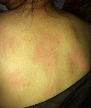 后背痘痘一堆,后背一大片痘痘多年没好