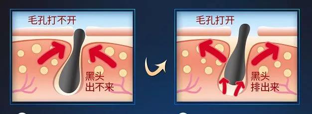 亲测真正有效去黑头粉刺产品,黑头连根拔起还会再长吗