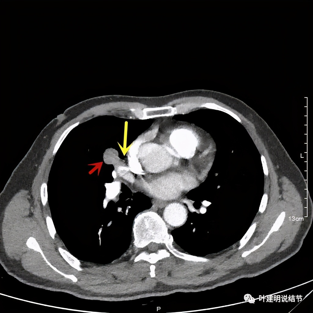 实性结节影要不要紧,实性结节穿刺活检为良性