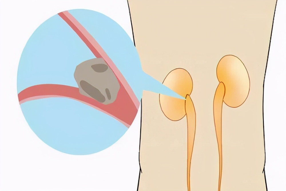 肾结石微创手术和开刀手术哪个好,肾结石微创手术开刀找不到石头