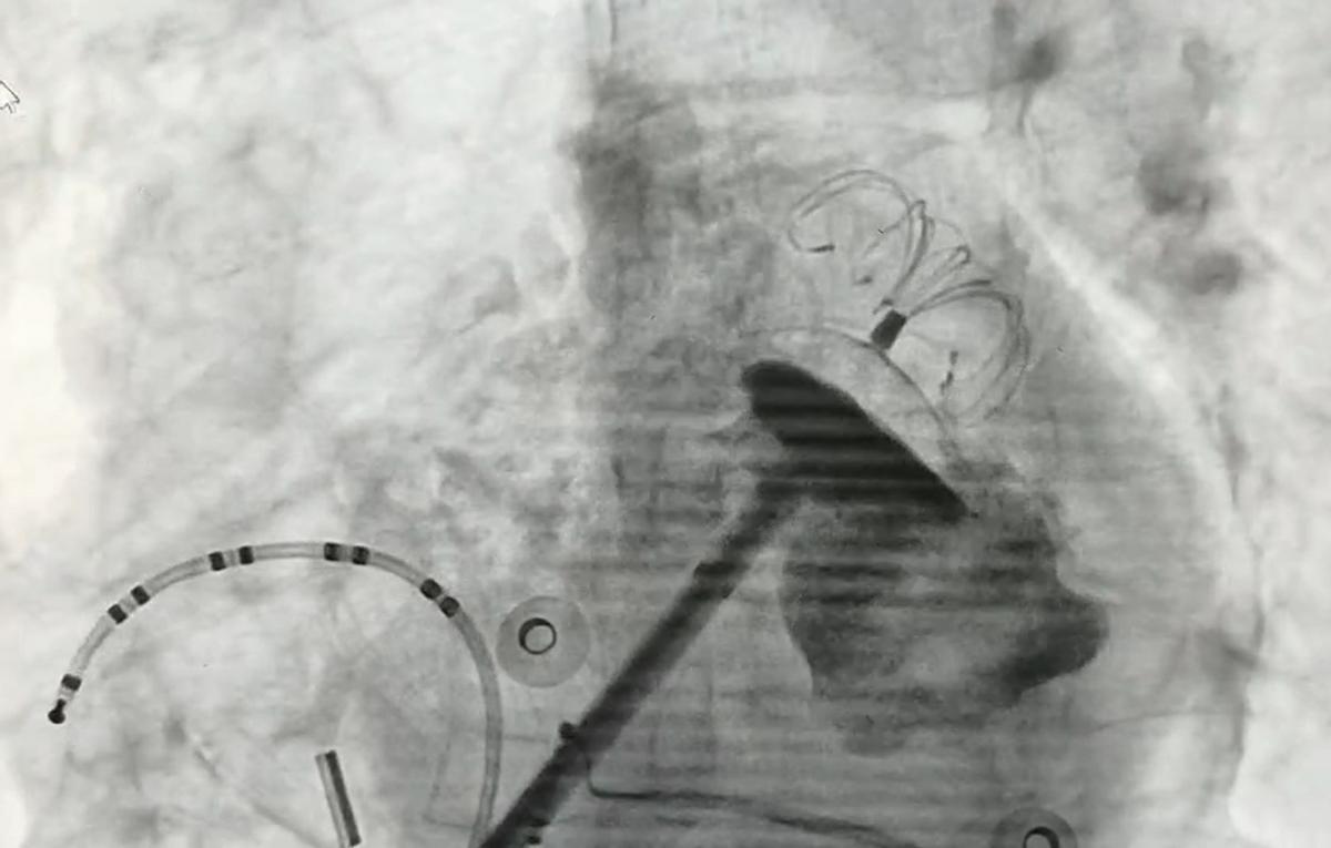 哈医大一院心血管内科三病房,哈医大治疗房颤