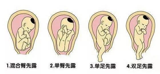 头先露可以顺产吗,头先露和枕先露各有几种胎位