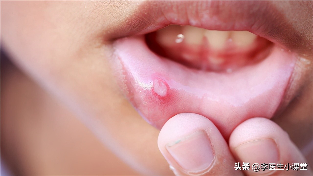 口腔溃疡很痛吃东西喊痛,口腔溃疡吃维生素b2还是维生素c好