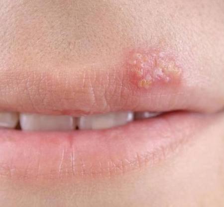 上火了嘴边起泡要弄破吗,上火嘴起泡是病毒感染吗