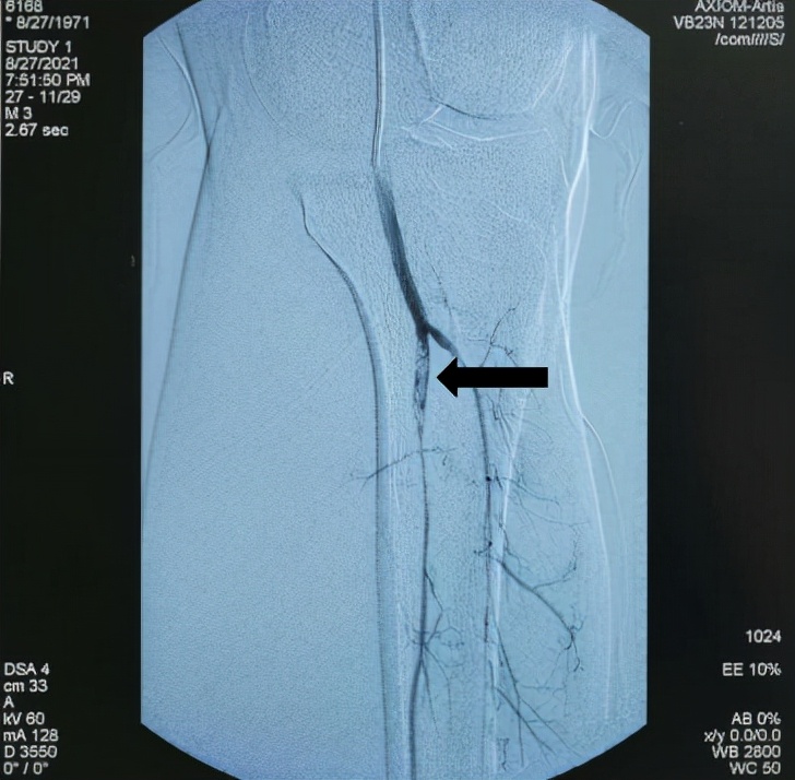 下肢动脉栓塞介入治疗后复发手术,下肢血管大面积栓塞怎么治