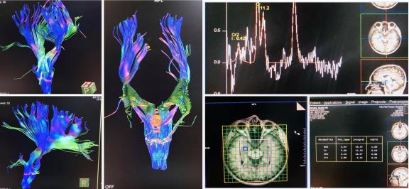 颅脑mr异常啥意思,颅脑mri未见明显异常说明什么