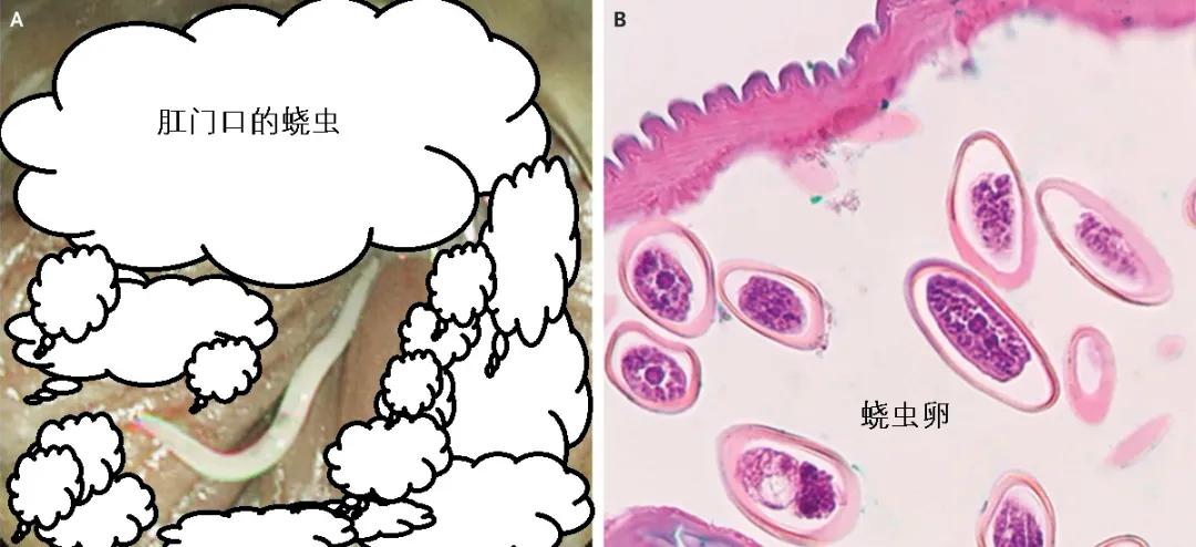 现在小学生要打虫吗,给小孩打虫的季节