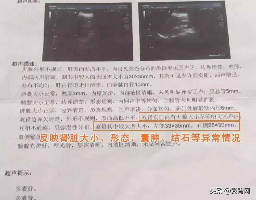 复查心里没底?简单易懂的肾内科检查解读,给每一位需要的肾友