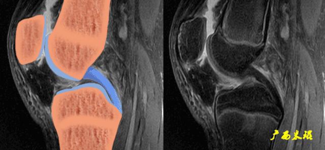 交叉韧带损伤的mr表现,后交叉韧带损伤的诊断实验