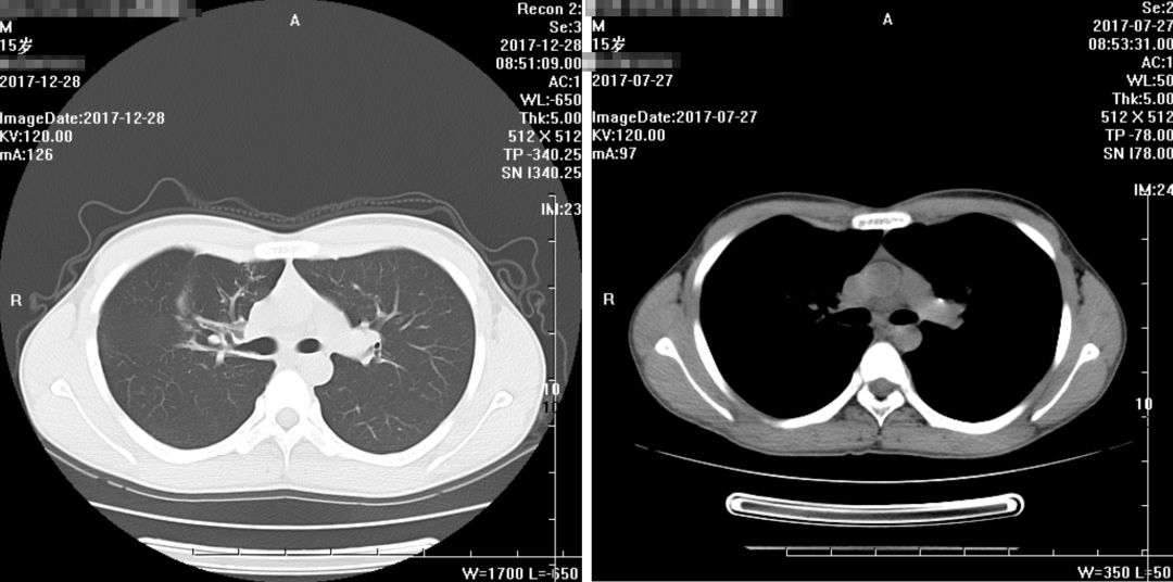 如何在CAP初始治疗后72h内进行病情评价？其成功关键有哪些？