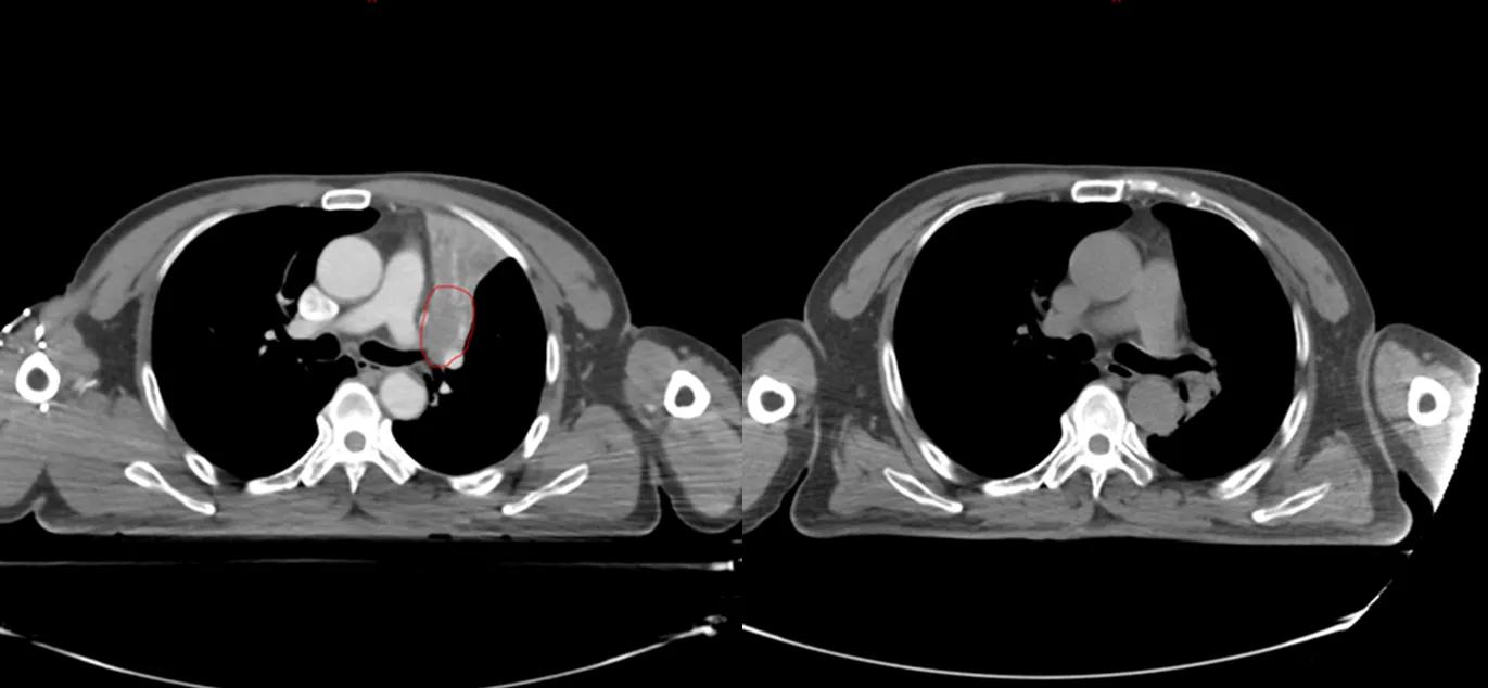 商陆治疗肺癌晚期,硼中子治疗晚期肺癌