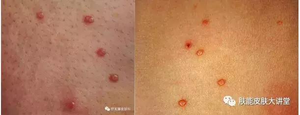 传染性软疣为何叫水瘊子,水瘊子和传染性软疣一样吗