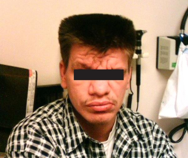 易跟湿疹混淆的罕见病：高IgE综合征什么样疾病？