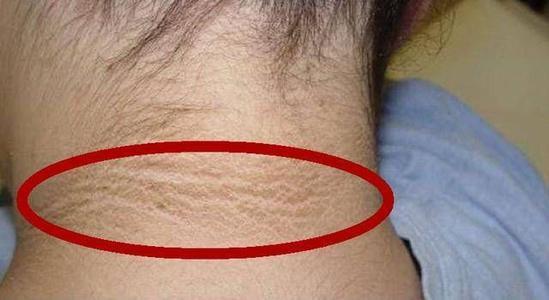 脖子旁边黑黑的洗不干净,脖子后面黑洗不掉图片