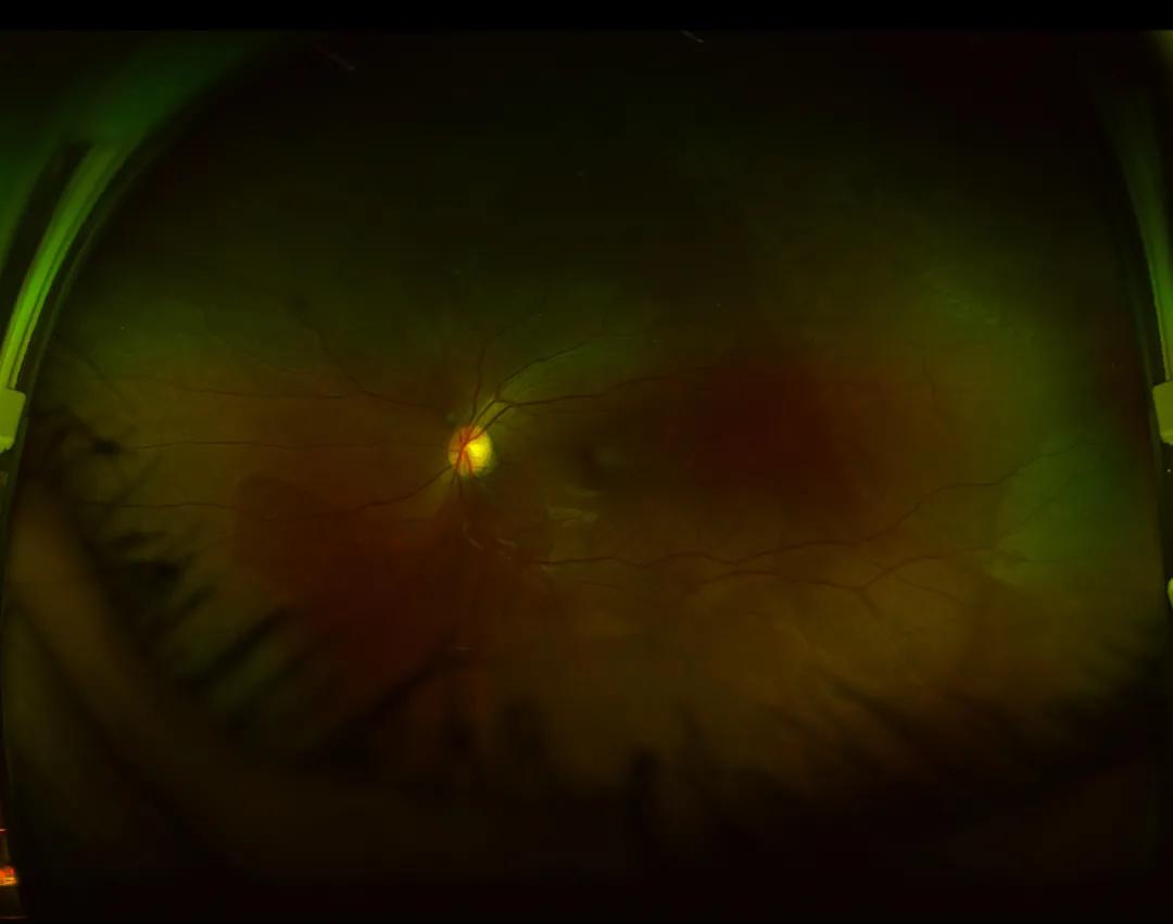 眼前突然出现黑影还很难受,眼前总有黑影飘是怎么了