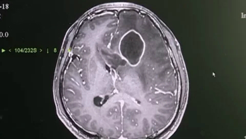 男子因其痘痘引发颅内脓肿,二十多岁小伙子肛周脓肿