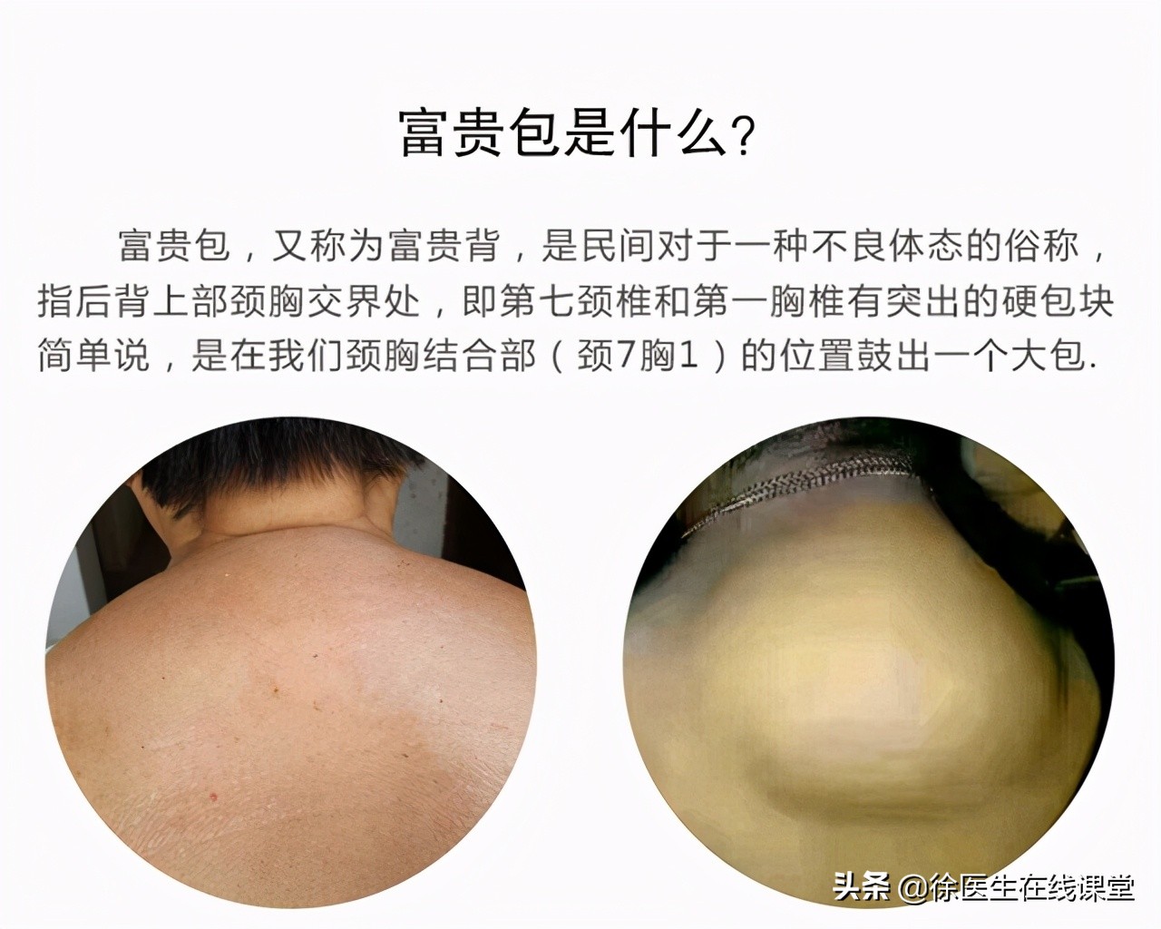 脖子上长富贵包三招教你调整颈椎,颈部上长了个富贵包怎么治疗