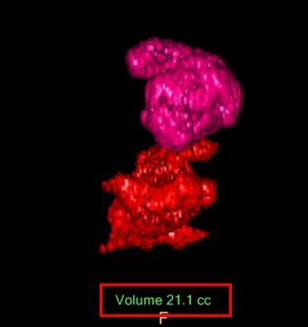 ct后处理重建技术,ct后处理技巧