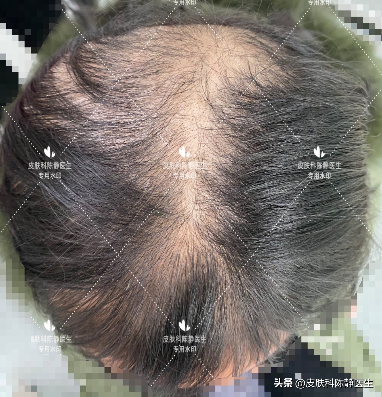 家长揪孩子头发,孩子爱揪自己头发怎么办